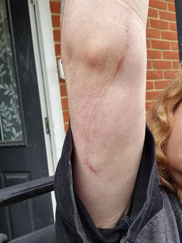 It has been a whole year since my cubital and carpal tunnel surgery! I remember being so utterly terrified. It has been wonde...