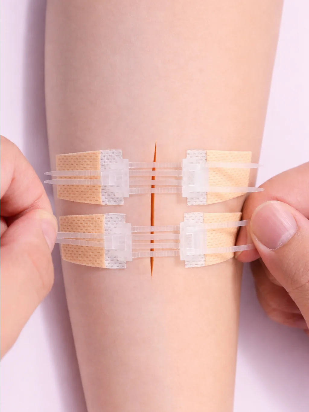 Wound Closure Devices (Zip-Stitches, Micromend, Clozex) product image (1)