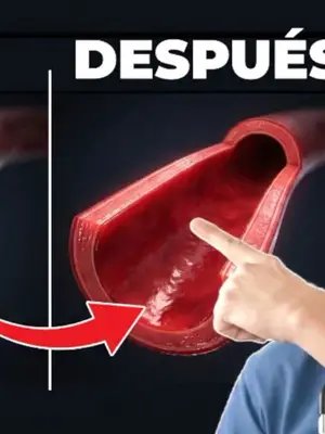 La MEJOR Comida que DESTAPA tus arterias (Con Respaldo Científico) Si experimentas síntomas silenciosos de arterias tapadas en el cuello o pecho, el problema real es la inflamación endotelial crónica. Te explico cómo repararla.    Si quieres completar tu estrategia cardiovascular, mira este video: https://youtu.be/tArSV1ekXvc  Por años te han hecho creer que tus arterias son simples tuberías que acumulan placa y que requieres purgas extremas. La realidad clínica es diferente: el daño ocurre en el glicocálix vascular, el 
