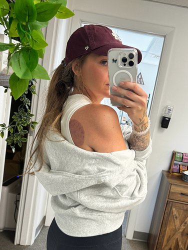 Let’s talk about cupping 🟣 Yes, this bruise matches the color of my hat, and it’s not from an injury. It was the result of cu...