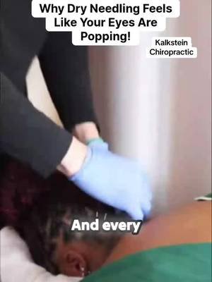 A little behind-the-scenes insight into dry needling. Dr. Nick shares his personal experience with this commonly treated area. #DryNeedling #PatientEducation #ChiropracticCare #Recovery #KalksteinChiropractic