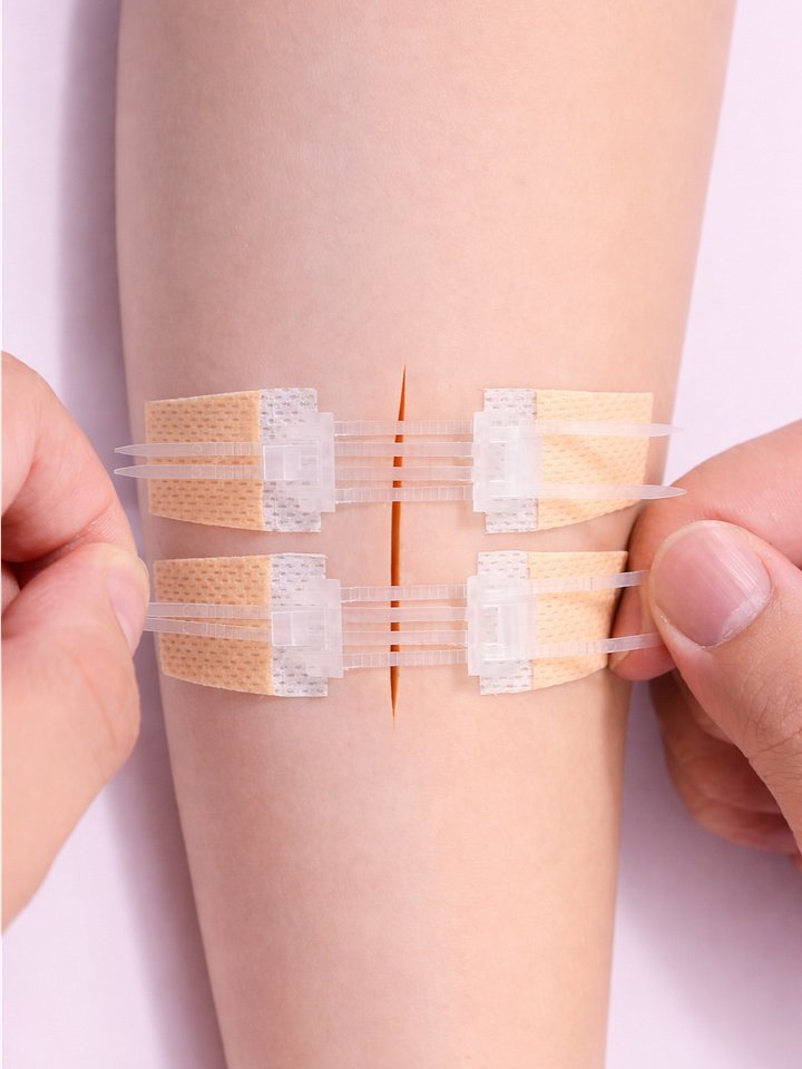 Wound Closure Devices (Zip-Stitches, Micromend, Clozex) product image (1)