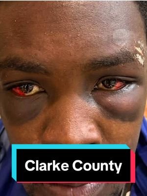 🔥SHARE🔥 🚨 CLARKE COUNTY, MISSISSIPPI 🚨 Another family is speaking out about what they say happened inside the Clarke County Jail. Since November, at least six nonviolent inmates from Meridian have reportedly been beaten while housed in that jail, either by other inmates or staff. Now this man was sent from Meridian to Clarke County on a trespassing charge. His family says he was not in his right state of mind and should have been cited out or placed somewhere safe. Instead, they say he was moved into another cell Monday, beaten, and then released today without proper medical attention. His family had to take him straight to Anderson Hospital. Now his mother, Lashonda Grady, is asking for help paying her son’s hospital bill. This is not just one story anymore. This is starting to look like a pattern. 🔥SHARE THIS 🔥 #m#mississippif#fypt#themidnightburnf#foryoupaget#truecrime