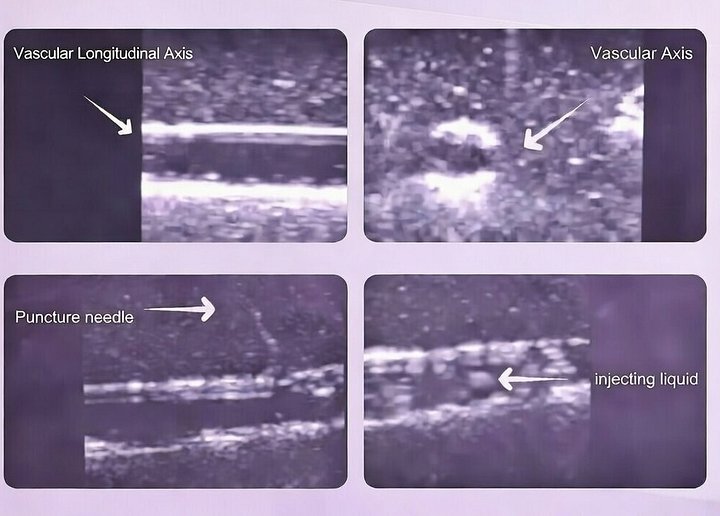 Ultrasound-Guided Vascular Puncture Training Model product image (2)
