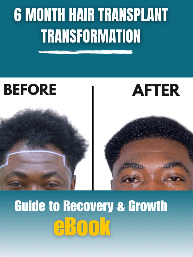 My 6-Month Hair Transplant Transformation Guide product image (1)