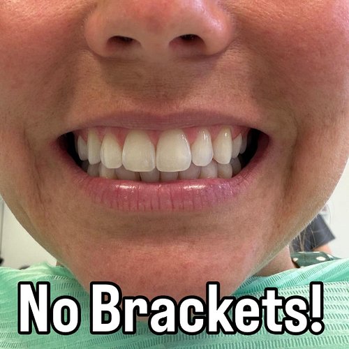 I’m almost done with my mouth journey thanks to @malo.clinic From a chipped tooth to a fixed jaw to straight teeth 😅 Just a f...
