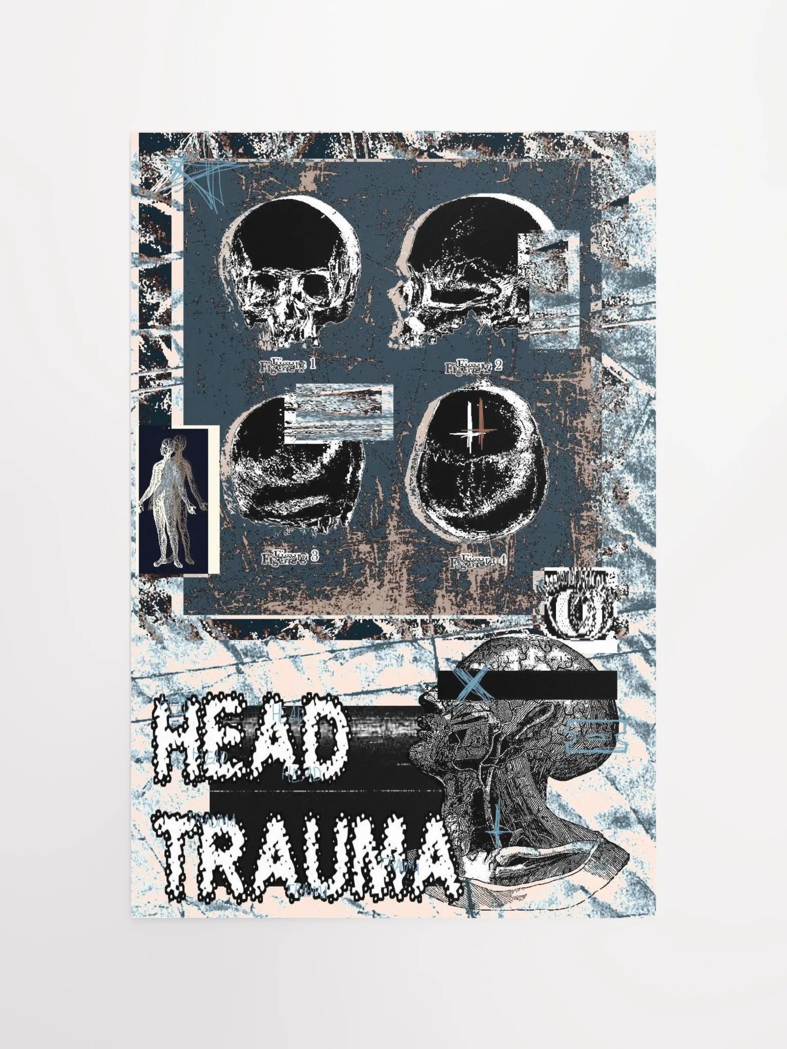 head trauma print product image (4)