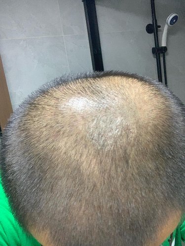 My hair grows back . I’m not balding anymore