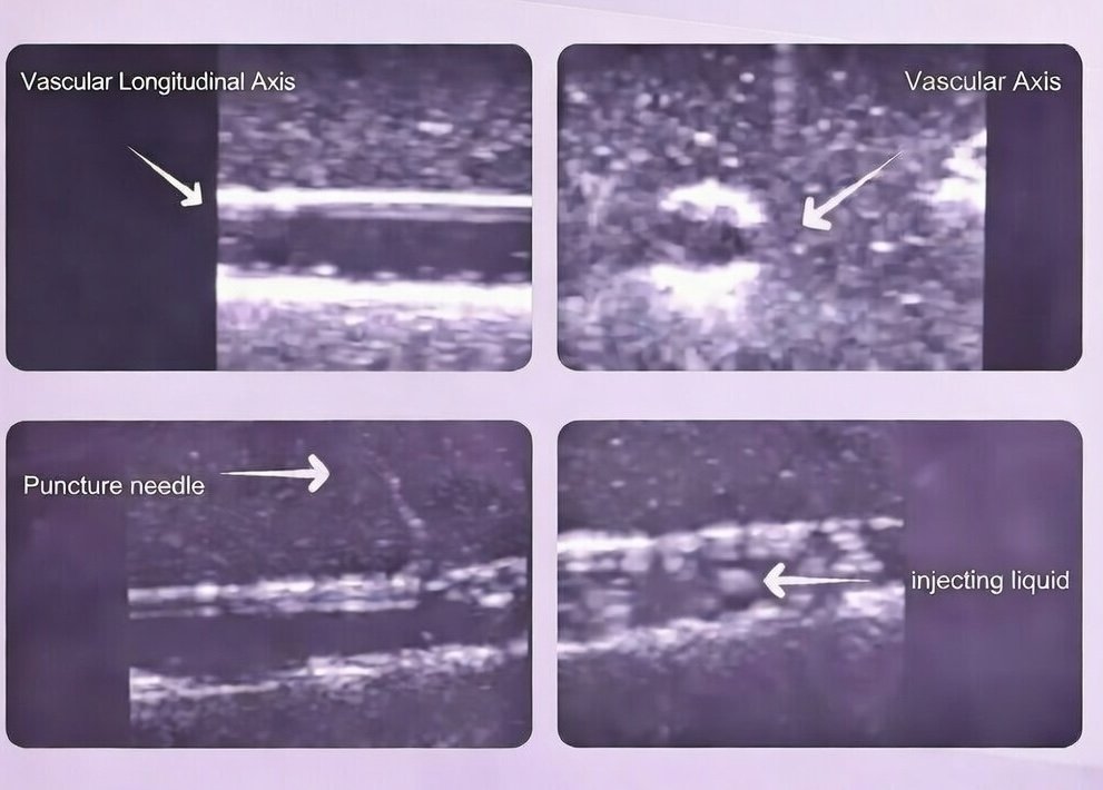 Ultrasound-Guided Vascular Puncture Training Model product image (2)