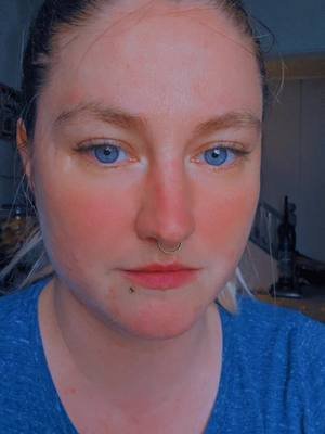2 years, no diagnosis, multitude of symptoms and every test comes back normal...#mysteryillness #autoimmunedisease #malarrash #rosacea #whoknows 