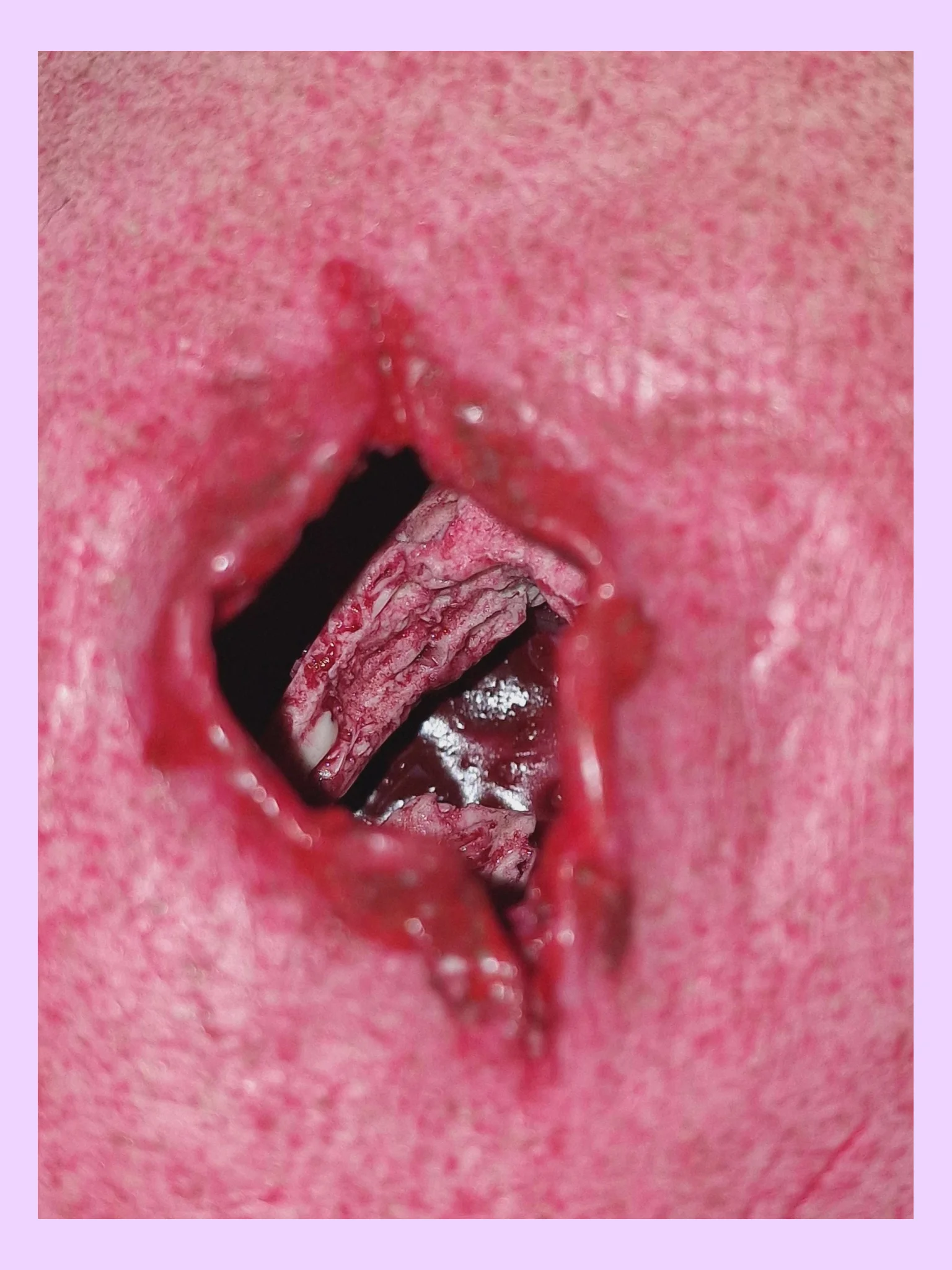 Hyperrealistic Wound Packing Trainer with Broken Bone product image (3)