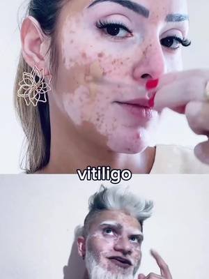 I don't judge her, but I wish she would embrace who she is. Having vitiligo is like a work of art. #VitiligoBeauty #EmbraceYourself #NaturalBeauty #UniqueSkin #confidence 