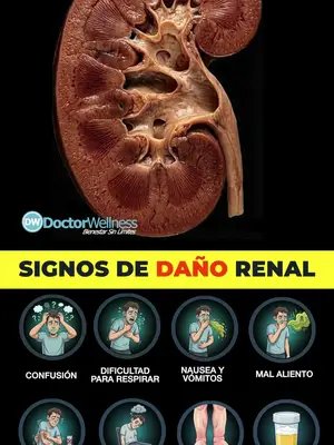 8 SIGNOS DE ALARMA de Falla Renal ¡NO LOS IGNORES!  Cambios en la orina  Esto es lo más evidente. Puede que necesites orinar con más frecuencia (especialmente de noche) o con menos frecuencia de lo normal.  La orina puede verse turbia, de color oscuro (como té o cola) o tener sangre.  Orina espumosa: Si hay mucha espuma que requiere vaciar el inodoro varias veces para que desaparezca, indica presencia de proteínas en la orina.  Hinchazón (Edema)  Cuando los riñones no pueden eliminar el exceso de líquido, este se acumula en el cuerpo.  Es común notar hinchazón en las piernas, tobillos, pies, o hinchazón alrededor de los ojos (especialmente por la mañana).  Fatiga extrema y debilidad  Los riñones sanos producen una hormona llamada eritropoyetina, que indica al cuerpo que produzca glóbulos rojos. Si los riñones fallan, hay menos glóbulos rojos para transportar oxígeno, lo que causa anemia y una sensación de cansancio profundo y falta de energía.  Piel seca y picazón intensa (Prurito)  Los riñones eliminan los desechos y el exceso de líquido de la sangre. Cuando fallan, la acumulación de desechos (como el fósforo) en la sangre puede causar picazón severa que no mejora con cremas hidratantes.  Sabor metálico en la boca o aliento a amoníaco  La acumulación de toxinas en la sangre (llamada uremia) puede hacer que los alimentos tengan un sabor 