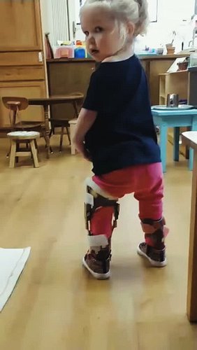 3 year old Ana - walking independently, less than FOUR months after her major double leg surgery! 😍 😍 😍