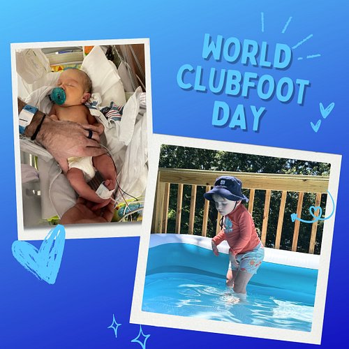 AMC Awareness Month - World Clubfoot Day 💙

In the NICU Harrison’s legs were so twisted that even changing his diaper felt im...