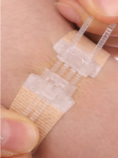 Wound Closure Devices (Zip-Stitches, Micromend, Clozex) product image (3)
