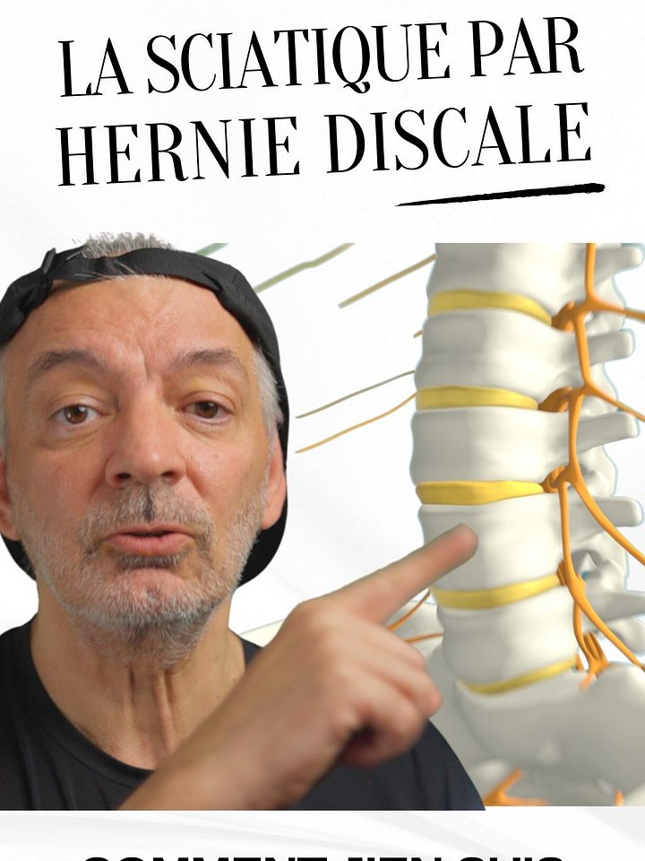 PDF - La Sciatique par hernie discale - Comment j'en suis venu à bout product image (2)