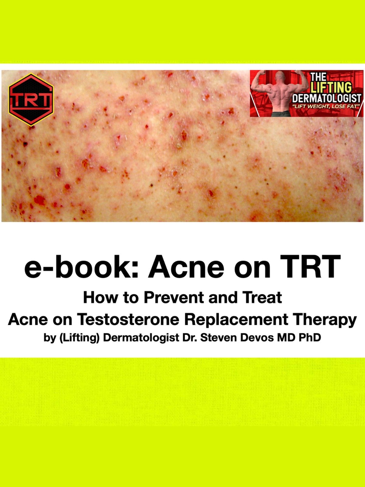 Acne on TRT e-book product image (1)